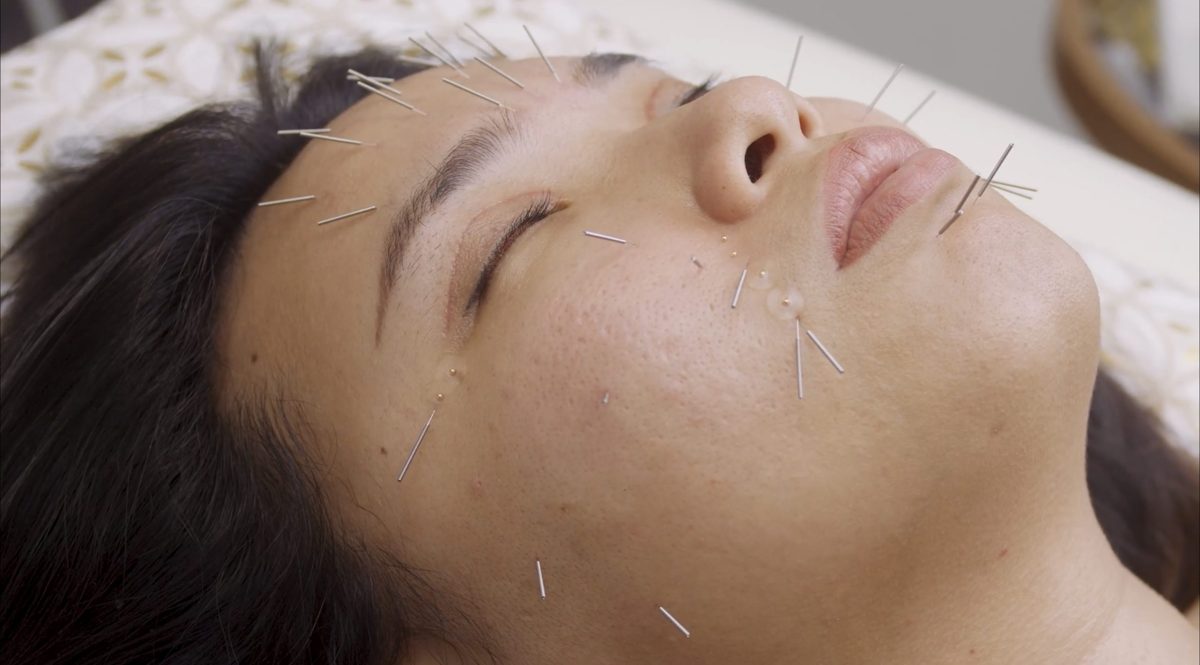 Aiguilles d'acupuncture posées sur le visage d'une patiente détendue