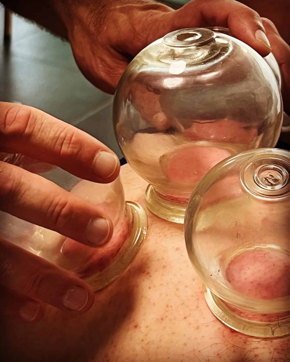 Ventouses en verre posées sur le dos pendant un soin